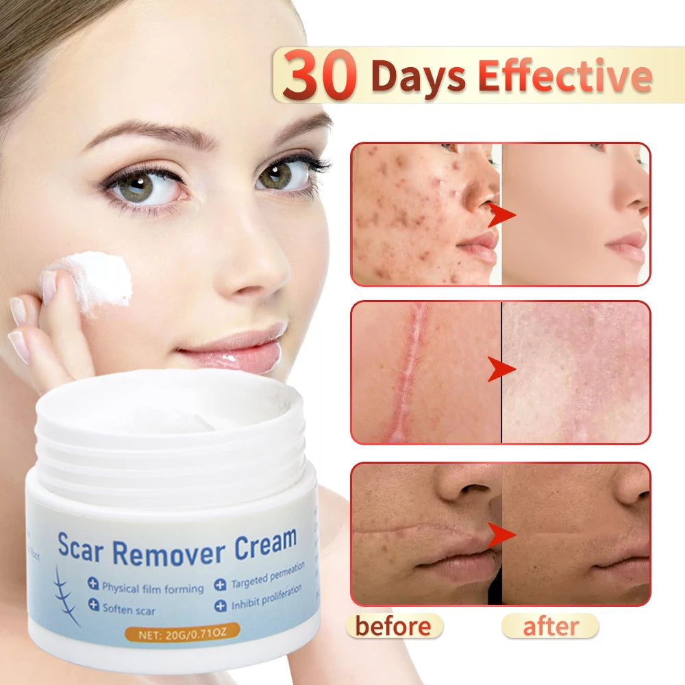 Fast Scar Removal Cream Treatment Stretch Marks Burn Surgical Scar Gel Acne Scar Spot Marks Repair Firming Smooth Body Skin Care