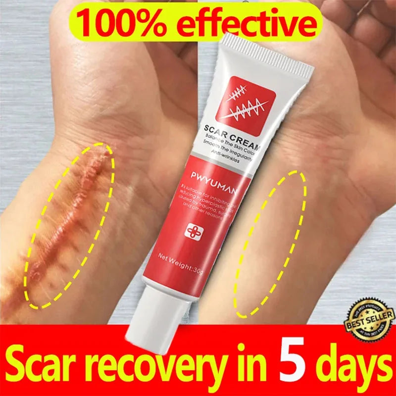 Scar Removal Cream Effective Stretch Marks Burn Surgical Scars Treatment Ointment Acne Spot Moisturizing Repair Body Skin Care